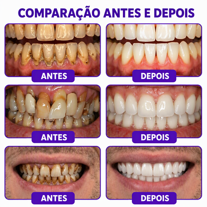 🇵🇹 Loja Oficial |🦷🍖 Rolimey® VioCore Pasta de dentes para o tratamento da inflamação das gengivas e da periodontite com veneno de abelha