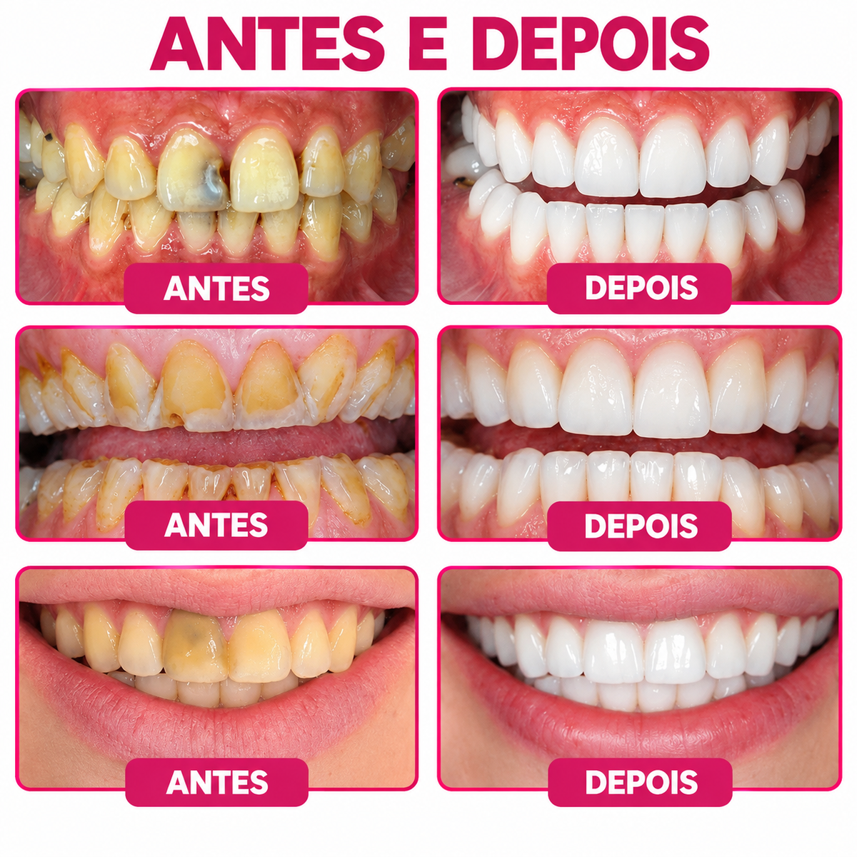 🇵🇹 Loja Oficial |🦷🍗 Rolimey® DenPerm – Gel natural de preenchimento do esmalte dentário para o tratamento de cáries