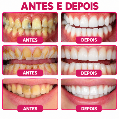 🇵🇹 Loja Oficial |🦷🍗 Rolimey® DenPerm – Gel natural de preenchimento do esmalte dentário para o tratamento de cáries