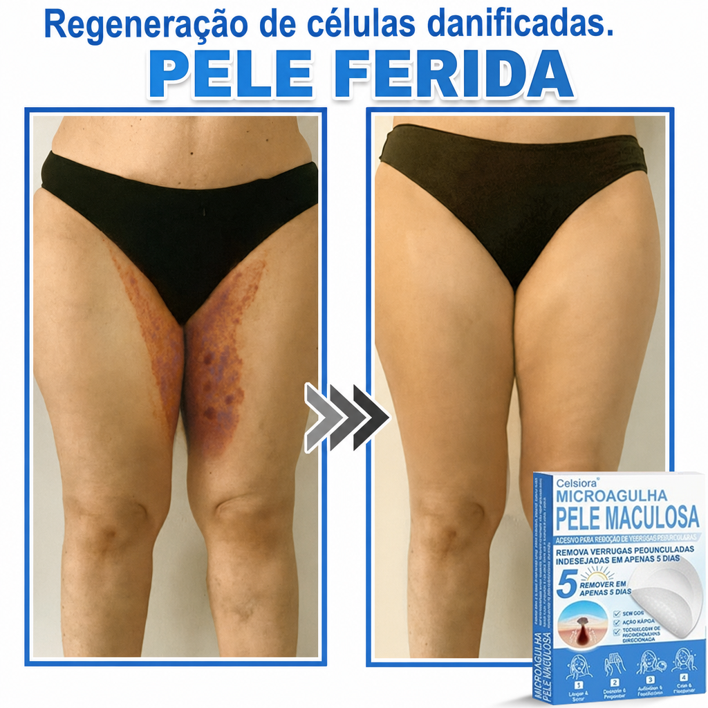 🏆🧨Celsiora® Adesivos 2 em 1 com Microagulhas e Hidrocolóide | Remove Verrugas, Acne, Verrugas Planas e Marcas de Pele | Melhora Rugas, Cicatrizes e Imperfeições | Adesivos Invisíveis em Forma de Estrela para Rosto e Corpo