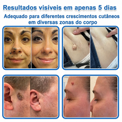 🏆🧨Celsiora® Adesivos 2 em 1 com Microagulhas e Hidrocolóide | Remove Verrugas, Acne, Verrugas Planas e Marcas de Pele | Melhora Rugas, Cicatrizes e Imperfeições | Adesivos Invisíveis em Forma de Estrela para Rosto e Corpo