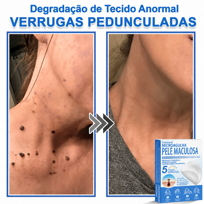🏆🧨Celsiora® Adesivos 2 em 1 com Microagulhas e Hidrocolóide | Remove Verrugas, Acne, Verrugas Planas e Marcas de Pele | Melhora Rugas, Cicatrizes e Imperfeições | Adesivos Invisíveis em Forma de Estrela para Rosto e Corpo