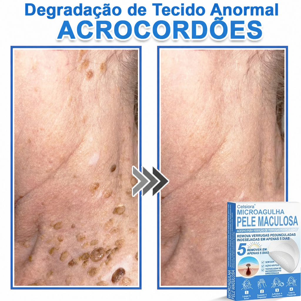 🏆🧨Celsiora® Adesivos 2 em 1 com Microagulhas e Hidrocolóide | Remove Verrugas, Acne, Verrugas Planas e Marcas de Pele | Melhora Rugas, Cicatrizes e Imperfeições | Adesivos Invisíveis em Forma de Estrela para Rosto e Corpo