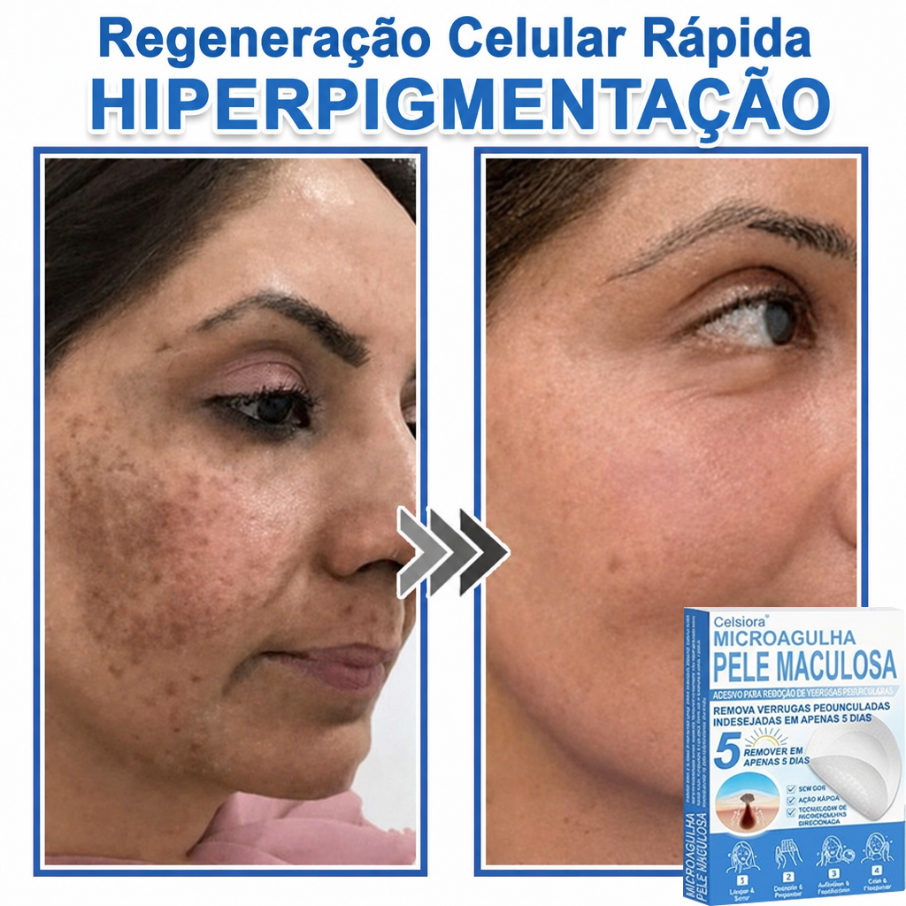 🏆🧨Celsiora® Adesivos 2 em 1 com Microagulhas e Hidrocolóide | Remove Verrugas, Acne, Verrugas Planas e Marcas de Pele | Melhora Rugas, Cicatrizes e Imperfeições | Adesivos Invisíveis em Forma de Estrela para Rosto e Corpo