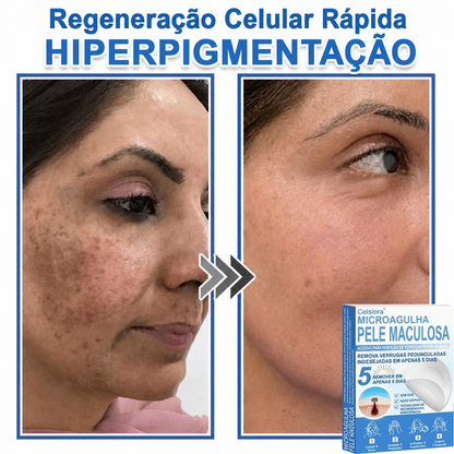 🏆🧨Celsiora® Adesivos 2 em 1 com Microagulhas e Hidrocolóide | Remove Verrugas, Acne, Verrugas Planas e Marcas de Pele | Melhora Rugas, Cicatrizes e Imperfeições | Adesivos Invisíveis em Forma de Estrela para Rosto e Corpo