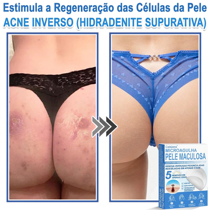 🏆🧨Celsiora® Adesivos 2 em 1 com Microagulhas e Hidrocolóide | Remove Verrugas, Acne, Verrugas Planas e Marcas de Pele | Melhora Rugas, Cicatrizes e Imperfeições | Adesivos Invisíveis em Forma de Estrela para Rosto e Corpo
