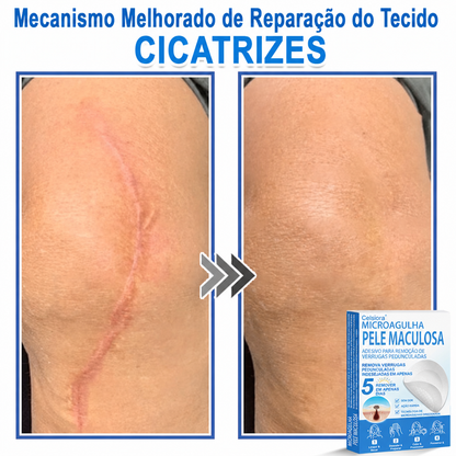 🏆🧨Celsiora® Adesivos 2 em 1 com Microagulhas e Hidrocolóide | Remove Verrugas, Acne, Verrugas Planas e Marcas de Pele | Melhora Rugas, Cicatrizes e Imperfeições | Adesivos Invisíveis em Forma de Estrela para Rosto e Corpo
